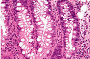 Cryptosporidiosis, or crypto, is a parasitic disease that causes symptoms similar to stomach flu. CREDIT NEPHRON / CREATIVE COMMONS