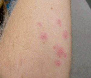 CDC image- photo A Broce, L Zurek- KSU