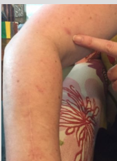Photo by Jim McLean/KHI News Service Amy Holdman pointing to the site of one of the 40 skin cancer biopsies she's undergone during the past year. Also visible is the scar on her forearm from the first of three surgeries to remove melanomas from both arms. -